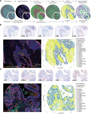 Improved overall survival in patients with high-grade serous ovarian cancer is associated with CD16a+ immunologic neighborhoods containing NK cells, T cells and macrophages